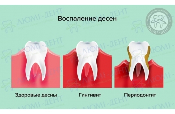 Воспалилась десна фото ЛюмиДент