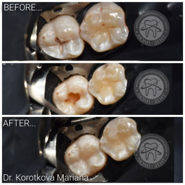 Примеры работ доктора Короткова М.И. Киев Люми-Дент
