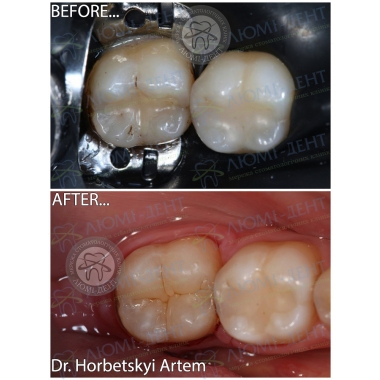 Пример работы врача стоматолога терапевта Горбецкого Артема 