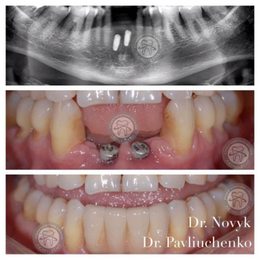 Работа врача хирург-имплантолог Павлюченко Е. Ю. Люми-Дент Киев