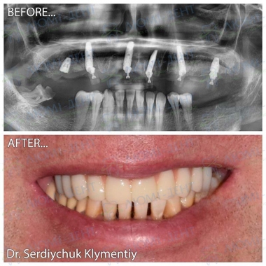 Сердийчук Климентий - врач хирург-имплантолог примеры работ