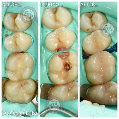 Примеры работ доктора Скубак Ольга Александровна стоматолог Люми-Дент