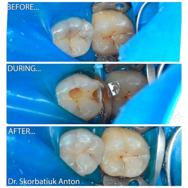 Пример работы врача стоматолога терапевта Скорбатюка А.А.