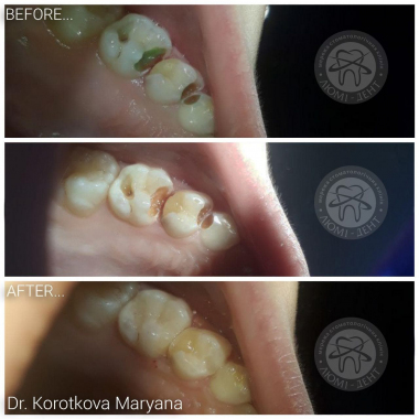 Примеры работ доктора Короткова М.И. Киев Люми-Дент