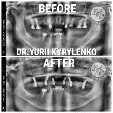 Пример работы хирурга имплантолога Кириленко Юрия