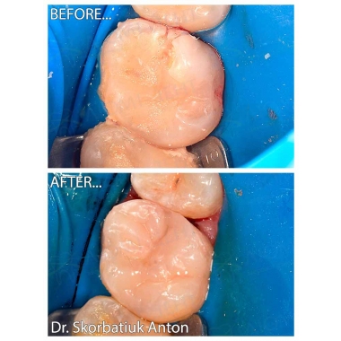 Пример работы врача стоматолога терапевта Скорбатюка Антона Александровича