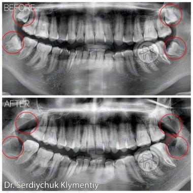 Сердийчук Климентий - врач хирург-имплантолог примеры работ