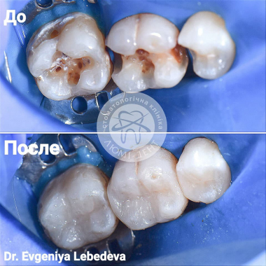 Зубы до и после Киев Люми-Дент Лебедева Евгения Ивановна 