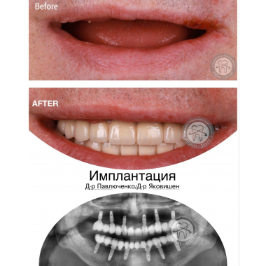 Врач хирург-имплантолог примеры работ доктора Павлюченко Е. Ю. Киев