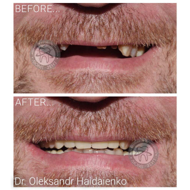 Примеры работ доктора Гайдаенко А. В. Врач стоматолог-ортопед