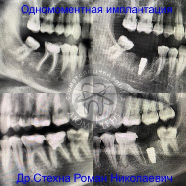 Примеры работ доктора Стехна Роман Николаевич Врач хирург-имплантолог