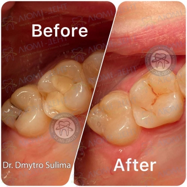 Пример работы врача стоматолога терапевта Сулимы Дмитрия 