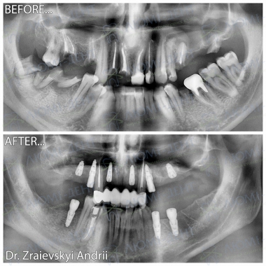 Примеры работ доктора Зраевского Андрея Киев ЛюмиДент