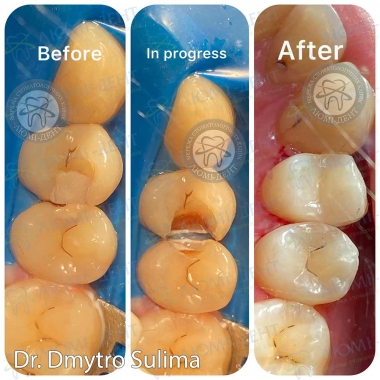 Пример работы врача стоматолога терапевта Сулимы Д.А.