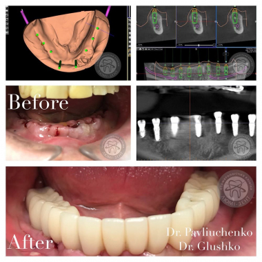 Импланты от врача Павлюченко Евгений Юрьевич  Люми-Дент