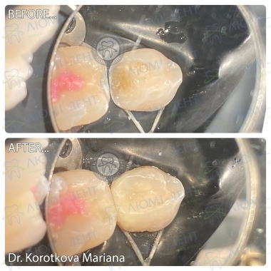Детский стоматолог Короткова М.И., примеры работ.