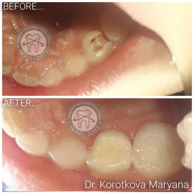 Примеры работ доктора Короткова М.И. Киев Люми-Дент
