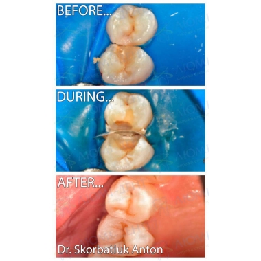 Пример работы врача стоматолога терапевта Скорбатюка А.А.