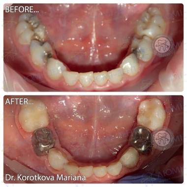 Примеры доктора Коротковой М.И. Киев Люми-Дент