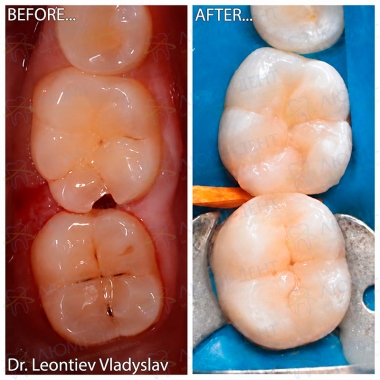 Леонтьев В.Р. - врач-стоматолог-терапевт, эндодонтист - примеры работ