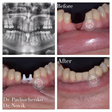 Импланты от врача Павлюченко Евгений Юрьевич  Люми-Дент