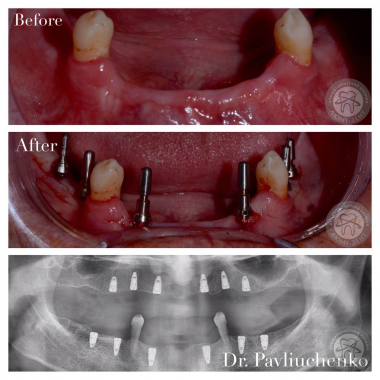 Врач хирург-имплантолог примеры работ доктора Павлюченко Е. Ю. Киев