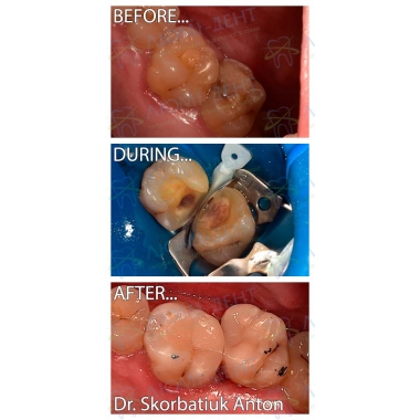Пример работы врача стоматолога терапевта Скорбатюка Антона Александровича