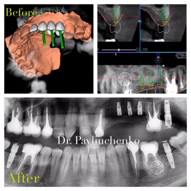 Врач хирург-имплантолог примеры работ доктора Павлюченко Е. Ю. Киев
