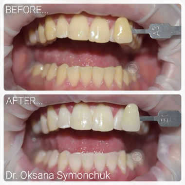 Примеры работ доктора Симончук О. В. зубной гигиенист