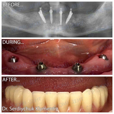 Сердийчук Климентий - врач хирург-имплантолог примеры работ