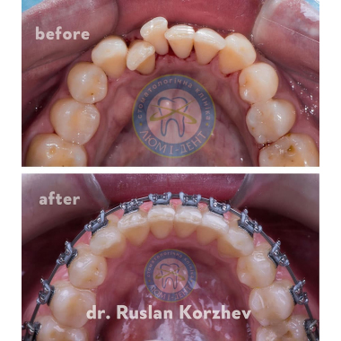 Брекеты Врач стоматолог-ортодонт Люми-Дент Киев Коржев Р. В.
