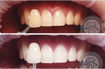Відбілювання Зубів 229 Фото До І Після- Люмі-Дент