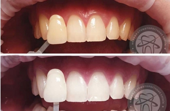 Відбілювання зубів фото робіт до та після - Люмі-Дент