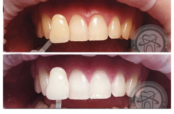 Whitening Teeth [229 Photos Before After] Kiev Lumident