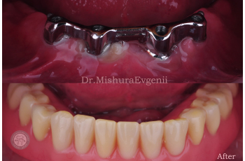 Протезування Зубів [229 Фото До Після] Лікування ЛюміДент Зубний Міст З 5 зубів Знімні Зубні Протези