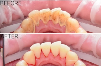 Чистка Зубів 229 Фото До Після Гігієнічна ЛюміДент