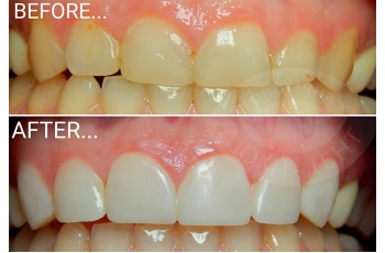 Teeth Restoration Photo Before After Kiev Lumident