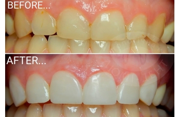 Реставрация зубов наращивание Киев фото до и после Люми-Дент 