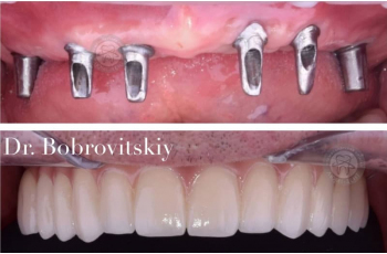 Teeth Implantation [229 Photos Before After] Kiev Lumi-Dent