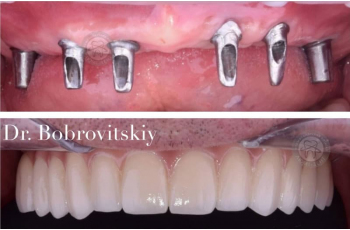 Teeth Implantation 229 Photos Before After LumiDent