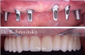 Teeth implantation Kiev photo of works Lumi-Dent