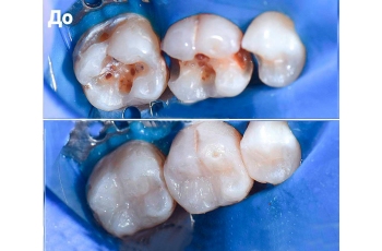 Teeth Fillings 229 Photos Before After Kiev Lumident