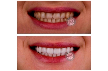 Veneers Lumineers 229 Photo Before After LumiDent