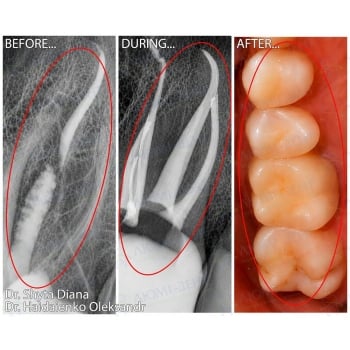 Before and After Treatment of Apical Periodontitis of Tooth 2.6