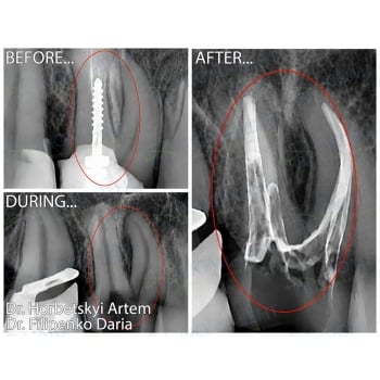 Before and After Treatment of Apical Periodontitis of Tooth 2.6
