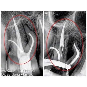 Before and After Root Canal Treatment of Tooth 1.6