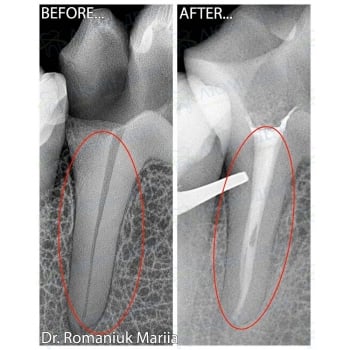 Before and After Treatment of Chronic Pulpitis of Tooth 4.6