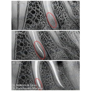 Endodontic retreatment with bypass of a fractured instrument and zirconia crown restoration