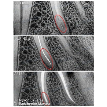 Endodontic retreatment with bypass of a fractured instrument and zirconia crown restoration