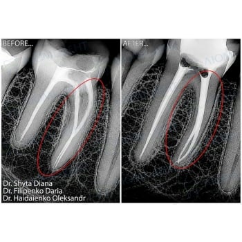 Root Canal Treatment and Restoration of Tooth 4.7